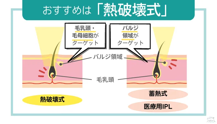 医療脱毛クリニック選びのポイント脱毛方式